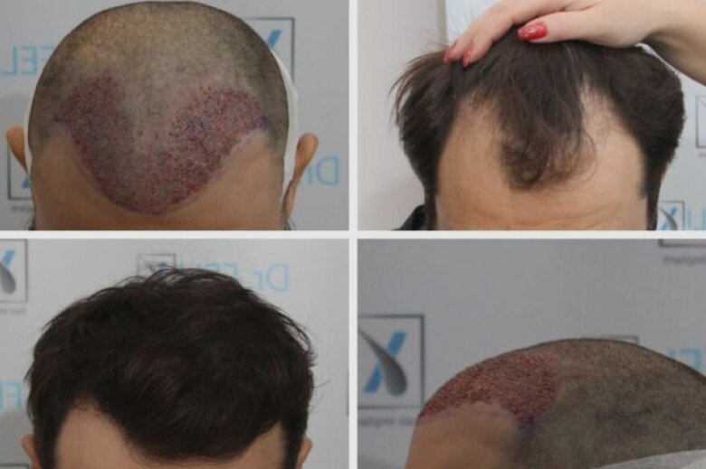 implant de par la clinica pasul spre un nou inceput pentru detalii vezi pe drfelixhairimplant ro 68aa9cc78f7d1